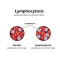 Lymphocytes above the normal range in the blood. Lymphocytosis. Vector illustration Royalty Free Stock Photo