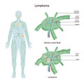 Lymphoma. Healthy lymph node structure and lymph node affected Royalty Free Stock Photo