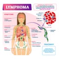 Lymphoma vector illustration. Labeled educational blood cancer type scheme.
