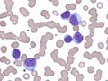 Lymphoplasmacytic lymphoma in peripheral blood.