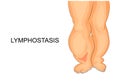 Lymphostasis. lymph edema of the feet Royalty Free Stock Photo