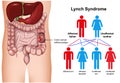 Lynch syndrome disease 3d medical illustration on white background