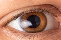 Macro eye photo. Keratoconus - eye disease, thinning of the cornea in the form of a cone. The cornea plastic Royalty Free Stock Photo