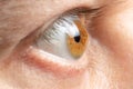 Macro eye photo. Keratoconus - eye disease, thinning of the cornea in the form of a cone. The cornea plastic. Ophthalmology Royalty Free Stock Photo