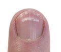 Macro of a Fingernail with leukonychia Royalty Free Stock Photo