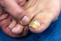 Macro of a human nail with fungal infection. Big toe with advanced onychomycosis