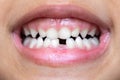 Macro of the mouth of a little girl who has lost a tooth Royalty Free Stock Photo