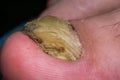 Macro photo of a human toenail with fungus