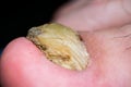 Macro photo of a human toenail with fungus