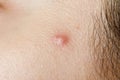 macro photo of a pimple