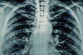 Macro photo of Radiological chest x-ray film with film grain. Asthma, COVID-19, coronavirus or pneumonia diagnostic Royalty Free Stock Photo