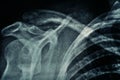 Macro photo of real x-ray film human shoulder with film grain Royalty Free Stock Photo