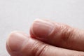 Macro photo of vertical ridges in fingernails Royalty Free Stock Photo