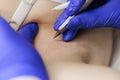 Macro photography cosmetic procedures for removing unwanted hairs using electrolysis