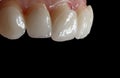 Dental ceramic veneers on the black background Royalty Free Stock Photo