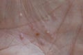 Macro photography of pustular psoriasis lesions, Palmoplantar psoriasis Royalty Free Stock Photo