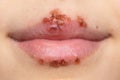 Close up of child mouth with cold sores Royalty Free Stock Photo