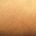 Macro scar on the human skin Royalty Free Stock Photo