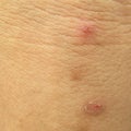 Macro scar on the human skin Royalty Free Stock Photo