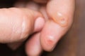 Macro shoot of warts on female finger