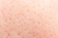 Macro shot of blackheads on facial skin, clogged pores Royalty Free Stock Photo