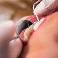 Macro shot of girl having dental check up in dental clinic. Dentist examining a patient`s teeth with dental tools Royalty Free Stock Photo