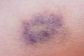 Macro shot of purple bruise on skin