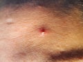 Red pimple with white pus squeezed out on tanned mature skin