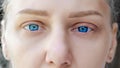 Macro shot of sad blue eyes and swollen eyelids. Young beautiful blonde looks into camera. Eyes of girl with long Royalty Free Stock Photo