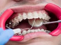 Macro shot of teeth with braces and dental retractor