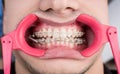 Macro shot of white teeth with braces and dental retractor at the dental office Royalty Free Stock Photo
