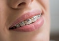 Macro shot of white teeth with braces. Female patient with metal brackets at the dental office Royalty Free Stock Photo