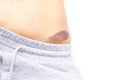 Macro shot of young woman with bruise, hematoma on pelvis