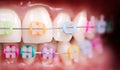 Macro snapshot of white teeth and ceramic braces with colorful rubber bands on them, latex cheek retractor on lips