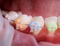 Macro snapshot of white teeth and ceramic braces with colorful rubber bands on them