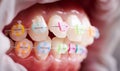 Macro snapshot of white teeth and ceramic braces with colorful rubber bands on them, latex cheek retractor on lips