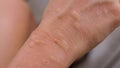 MACRO: Unrecognizable woman\'s arm is filled with nagging swollen mosquito bites.