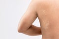 Macro white pityriasis or tinea versicolor on back skin. Used for skincare concept Royalty Free Stock Photo