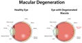 Macular Degeneration