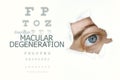 Macular degeneration disease poster with eye test chart and blue eye. Royalty Free Stock Photo