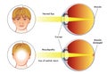 Maculopathy