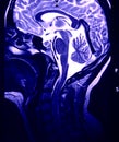 Magnetic Resonance of Brain, blue MR Royalty Free Stock Photo