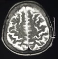 Magnetic Resonance Of Brain, MR