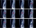 Magnetic resonance image of human spine with lordosis,Moderate compressiom fracture of T12