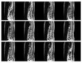 Magnetic resonance image of human spine Royalty Free Stock Photo