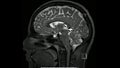 Magnetic resonance images of the brain MRI brain sagittal T2 weighted sequence