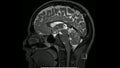 Magnetic resonance images of the brain MRI brain sagittal T2 weighted sequence