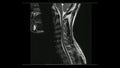 Magnetic Resonance images of Cervical spine sagittal T2-weighted images  MRI Cervical spine Royalty Free Stock Photo