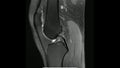 Magnetic Resonance images of The Knee joint Sagittal Proton density Images in cine mode