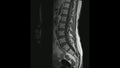 Magnetic Resonance images of Lumbosacral spine